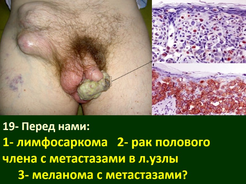 19- Перед нами: 1- лимфосаркома   2- рак полового члена с метастазами в